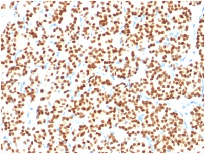Formalin-fixed, paraffin embedded human thyroidal carcinoma sections stained with 100 ul anti-PAX8 (clone PAX8/1491) at 1:300. HIER epitope retrieval prior to staining was performed in 10mM Citrate, pH 6.0.